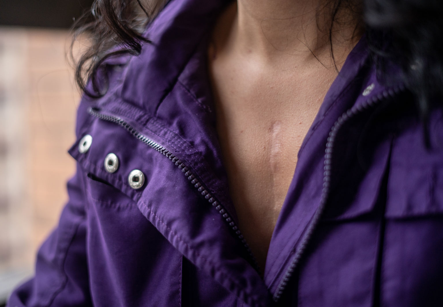 Kvinna med lila jacka med ett ärr på bröstkorgen