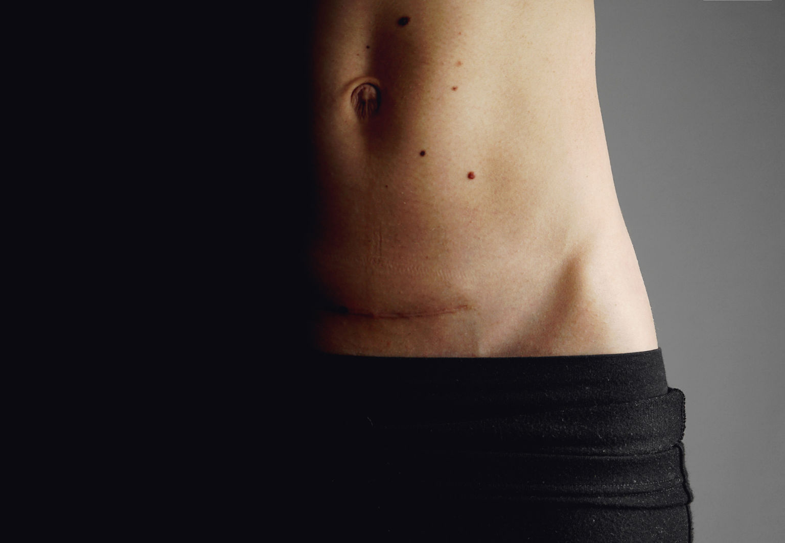 Närbild på en kvinnas mage och ett ärr efter ett kejsarsnitt